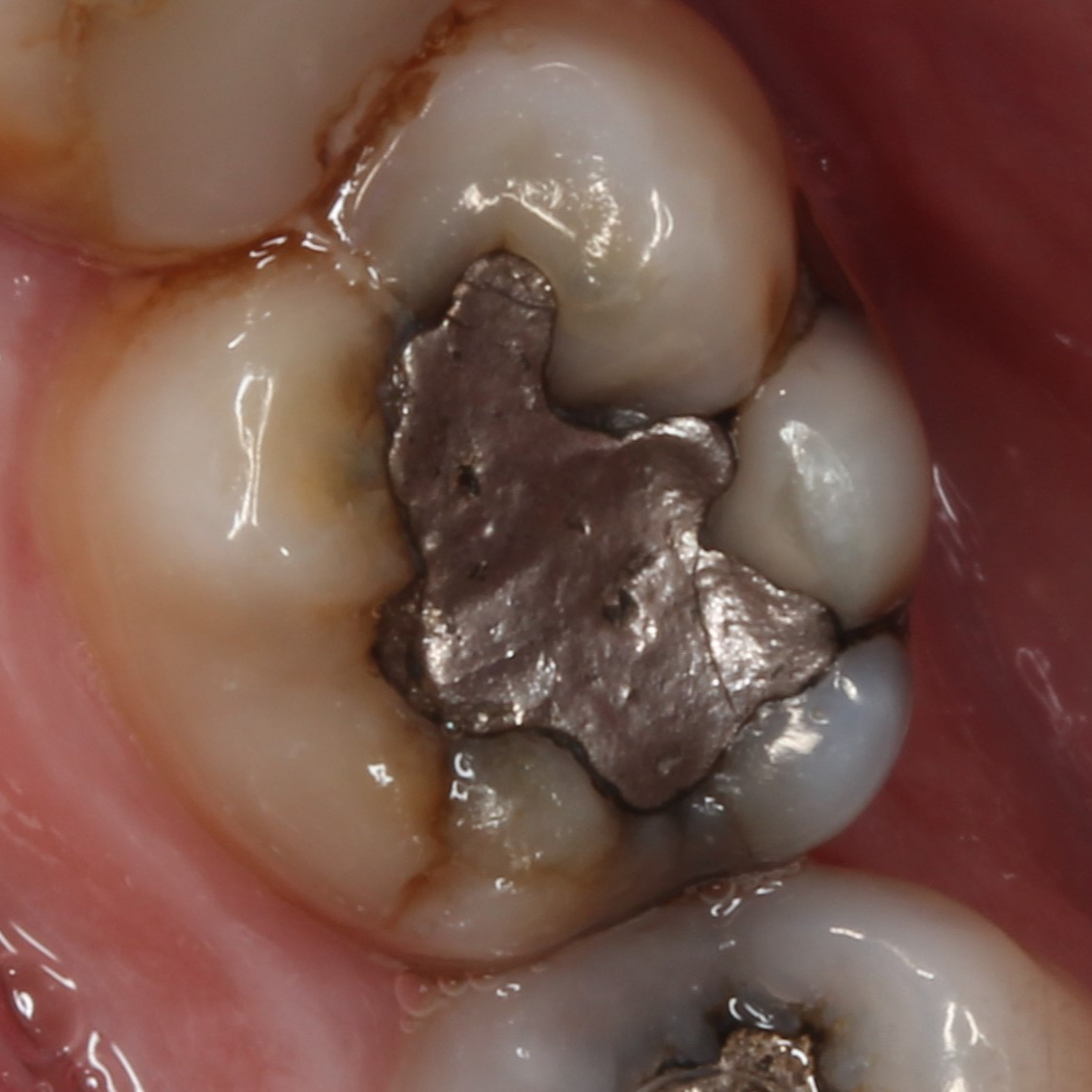 Before-Single visit full ceramic crown to restore a cracked and heavily filled lower molar