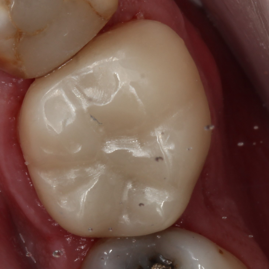 After-Single visit full ceramic crown to restore a cracked and heavily filled lower molar